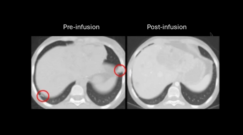 Pre- and post-infusion three-dimensional imaging shows that infused GPC3 CAR T cells induce significant antitumor responses in patients.