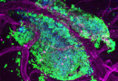 Image of the Month: A closer look at metastatic medulloblastoma