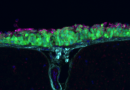 Partners in crime: Metastatic medulloblastoma recruits local fibroblasts to support its spread and growth