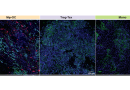 Study reveals heterogeneity of bone metastases across different and same cancer types