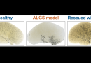 A new treatment can potentially change the outlook for patients with Alagille syndrome