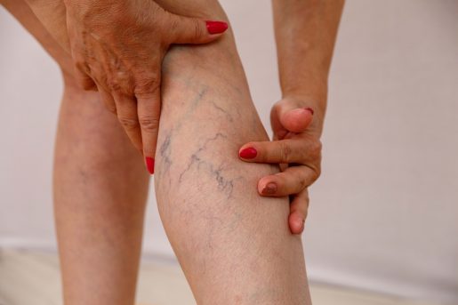Woman touching varicose veins on leg.