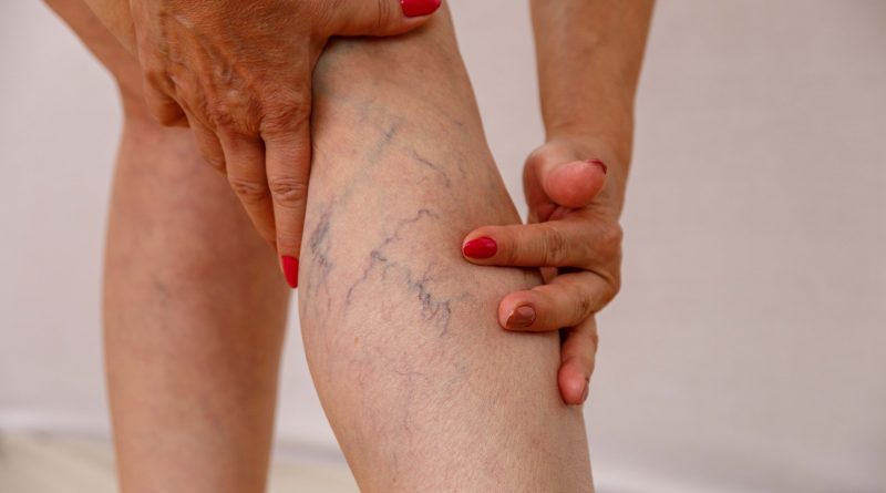 Woman touching varicose veins on leg.