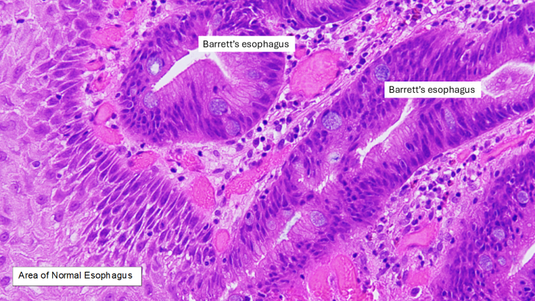 Blood vessels (magenta) intertwined with metastatic medulloblastoma tumor cells (green) nestled within the protective layers that surround the mouse spinal cord.