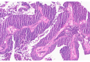 Multipronged approach reveals what makes some bladder cancers resistant to chemotherapy