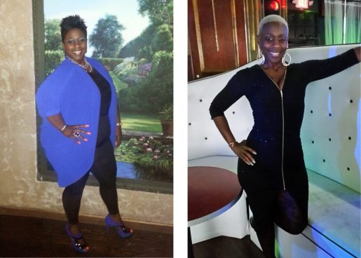 Sherry Matchett posing before and after weight loss surgery.
