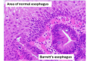 Image of the Month: Barrett’s esophagus
