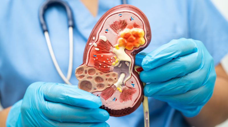 Doctor holds kidney model.