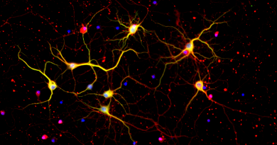 Close up of neurons from the brain cortex of a mouse with Huntington's disease.