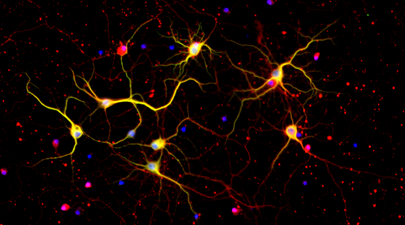 Close up of neurons from the brain cortex of a mouse with Huntington's disease.