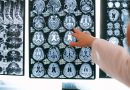 A closer look at brain tissue vulnerability in neurological disease